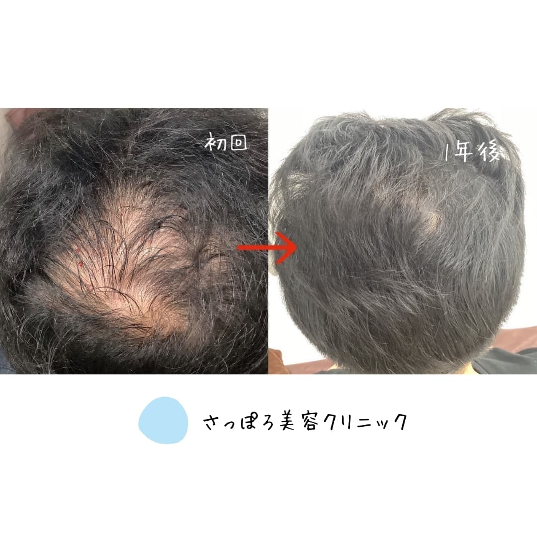 AGA治療