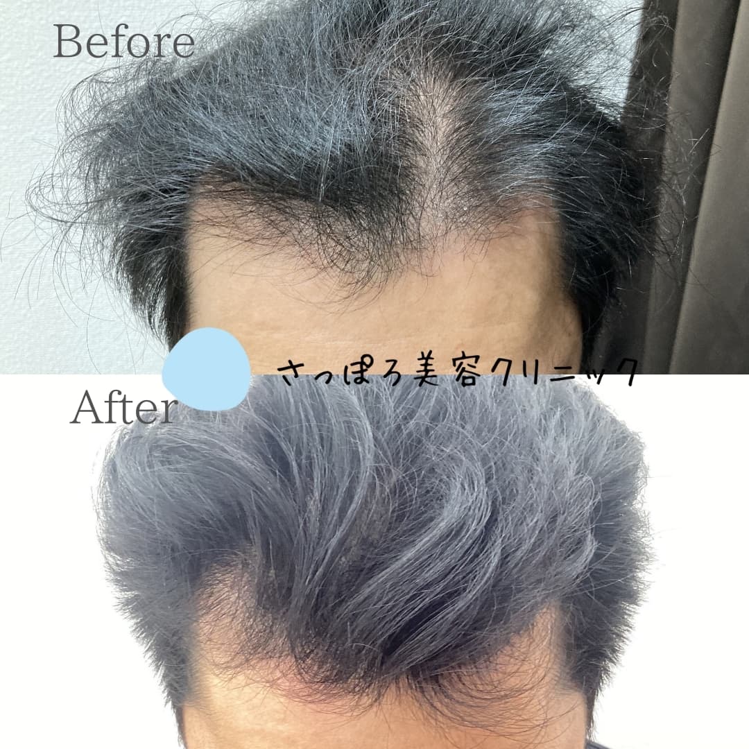 AGA治療